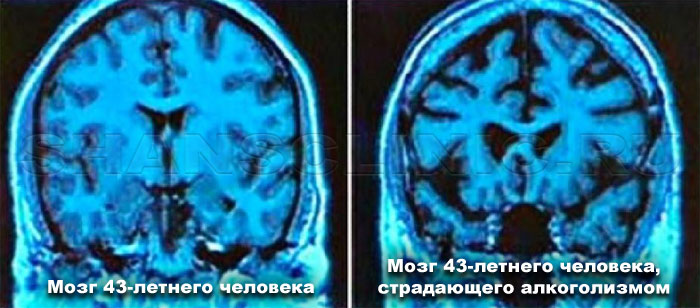 Мозг нормального человека и алкоголика